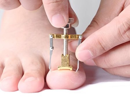 Ingrown Toe Nail Fixer Device on Sale